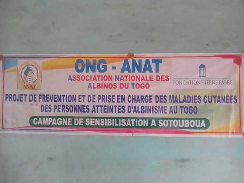 Article : Sotouboua/ L’ONG ANAT au secours des albinos du canton de Tchebebe